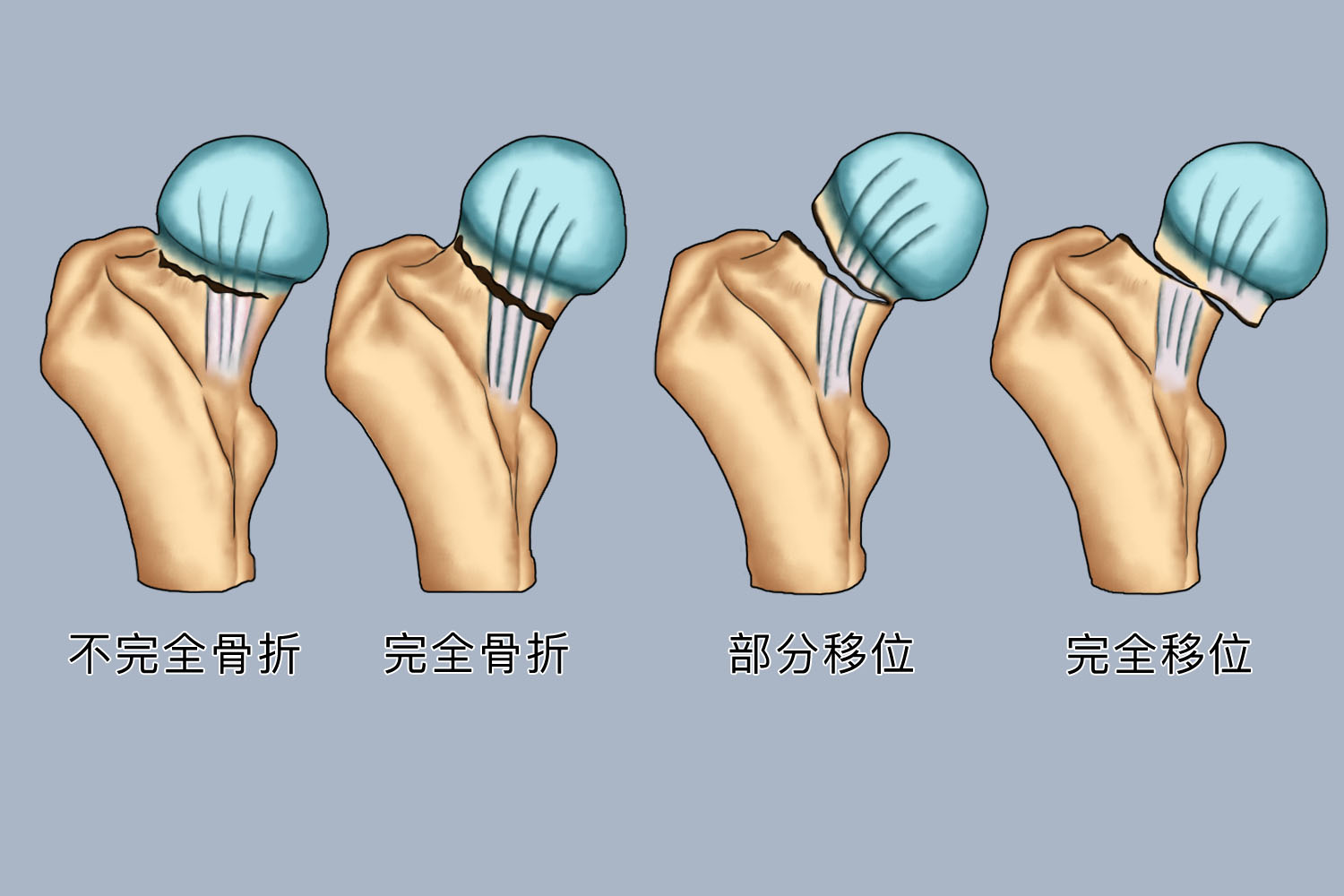 股骨颈骨折分型Garden图