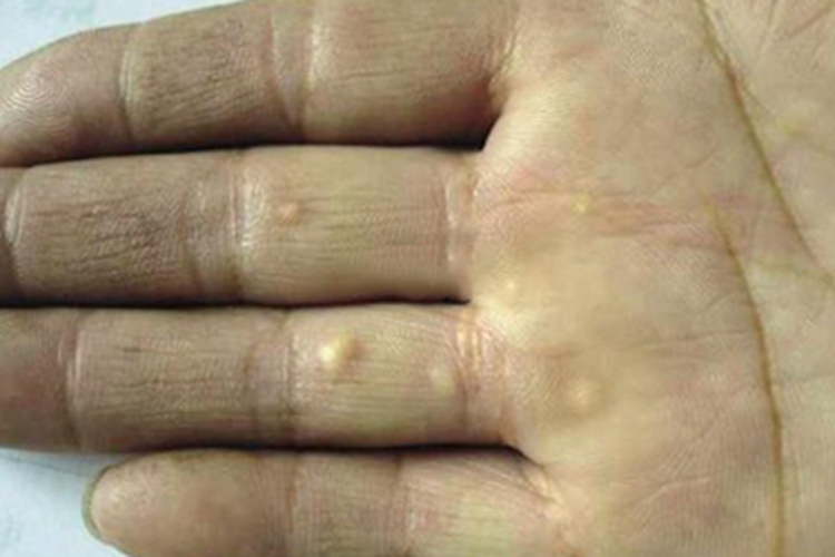 结节性黄瘤手掌疙瘩图