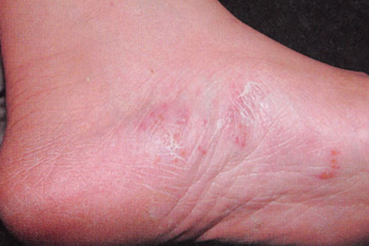 脚过敏丘疹水疱图