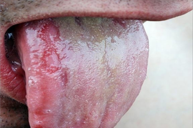 三期梅毒舌头症状图