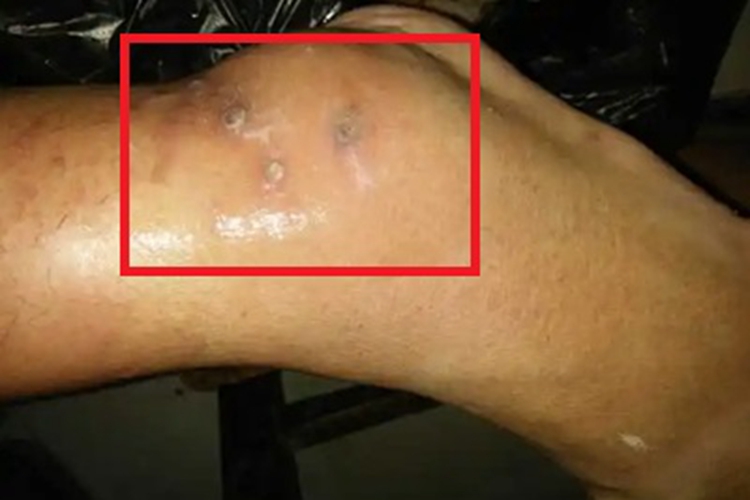 偶遇分枝杆菌感染化脓图