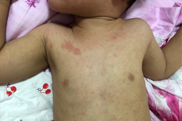 幼儿急疹全身斑丘疹图