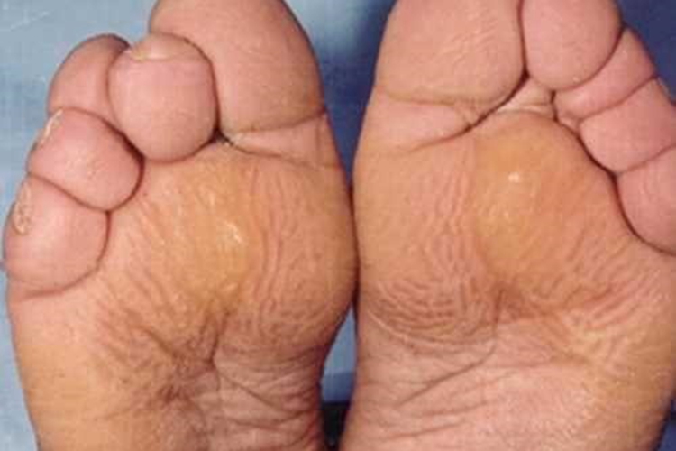 原发性骨膜增生厚皮症脚底症状图