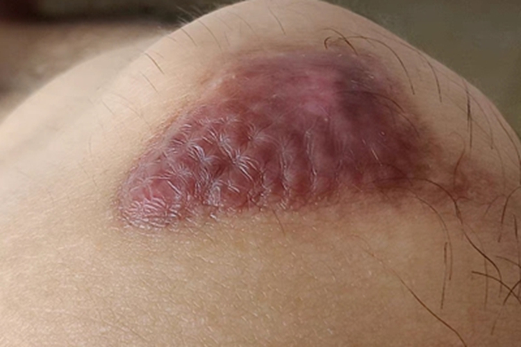 瘢痕疙瘩症状图