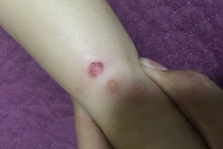 水痘腿水疱图