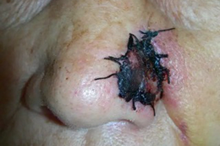 浅表型基底细胞癌鼻部症状图