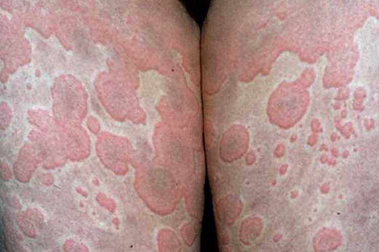 正常补体血症型大腿红斑图