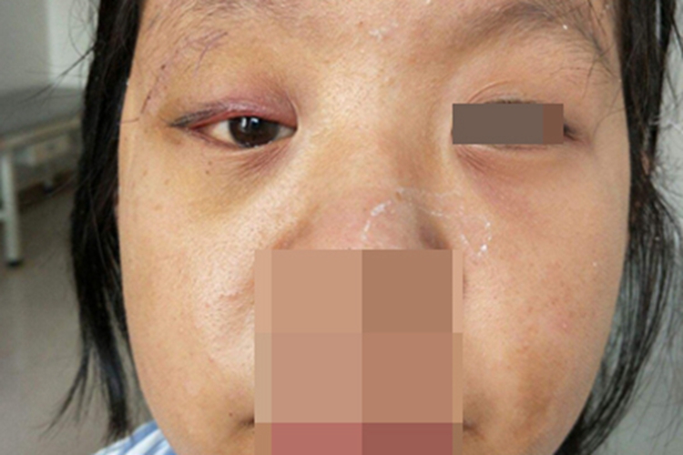 眼眶畸胎瘤症状图 眼眶畸胎瘤症状图