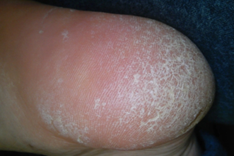 特应性皮炎脚后跟裂纹图