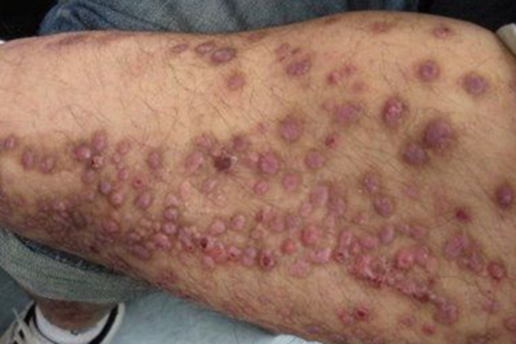 结节性痒疹小腿小红疙瘩图