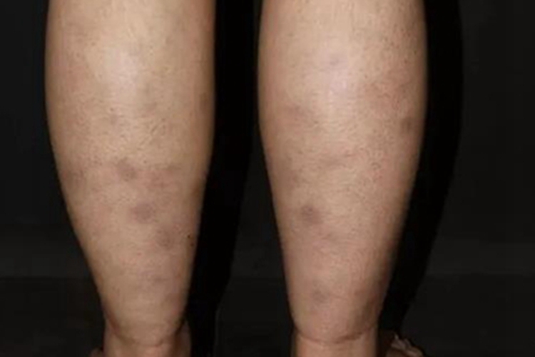 白塞病小腿有一块块黑斑图