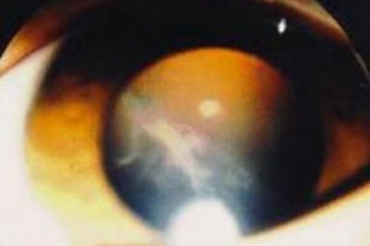 玻璃体疝角膜水肿图 玻璃体疝角膜水肿图