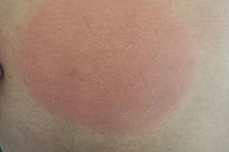 固定型药疹腹部红斑图 固定型药疹腹部红斑图