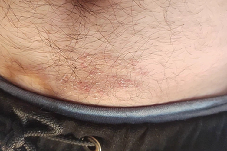 体癣下腹症状图 体癣下腹症状图