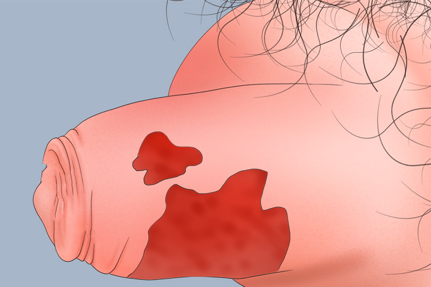 包皮血肿手绘图