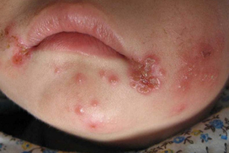 口唇疱疹口周糜烂图