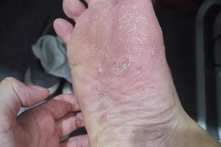 水疱型足癣脚底脱皮图