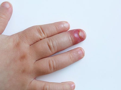 脓性指头炎常见于手指头,临床可表现为手指头呈现红肿,皮肤紧张发亮
