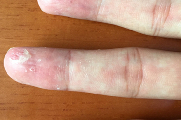 更年期角皮症手指脱皮有竖纹图