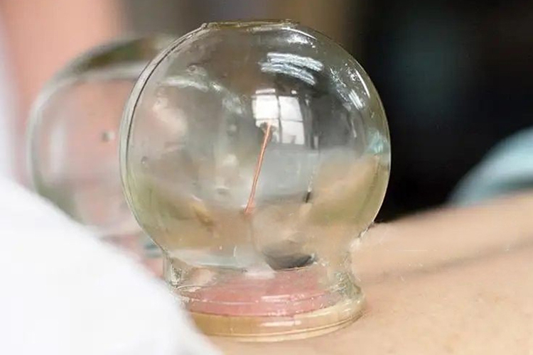 留针火罐法图 留针火罐法图