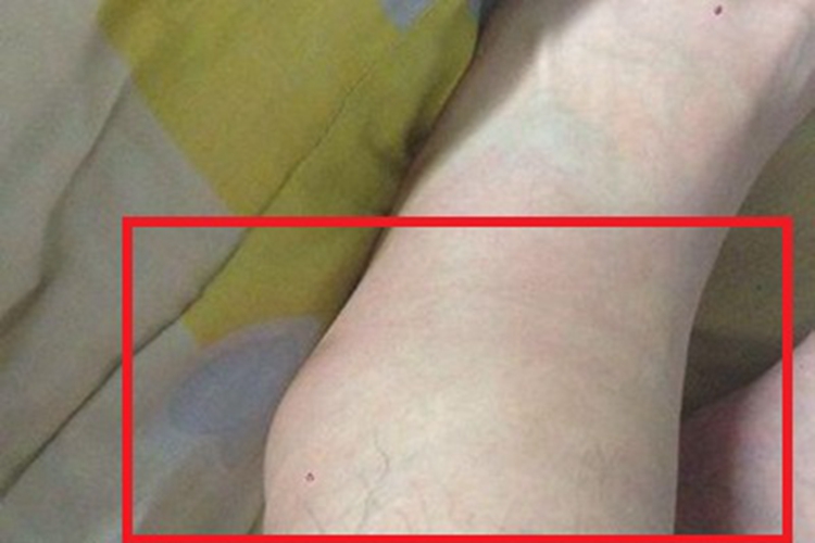 踝扭伤脚踝肿胀变粗图