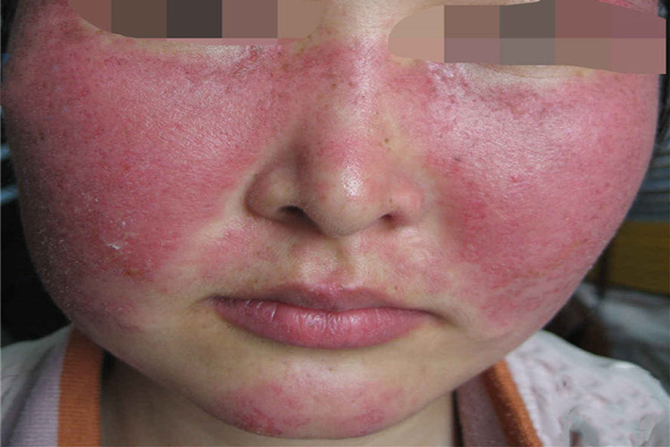 急性皮肤型红斑狼疮面部红斑图