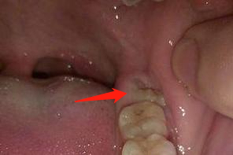 拔智齿后牙槽窝长平图