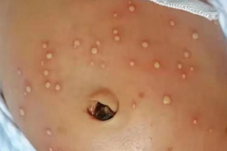 新生儿红斑腹部脓包图 新生儿红斑腹部脓包图