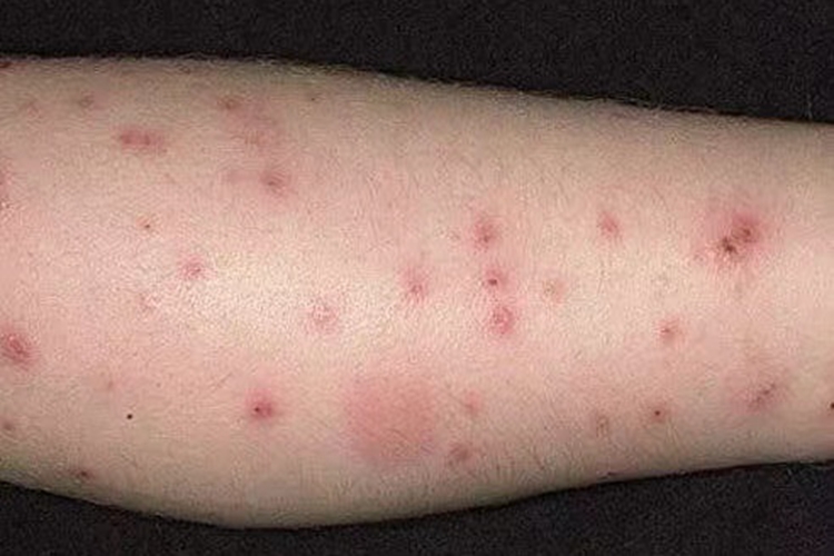 虫咬皮炎小腿结痂图