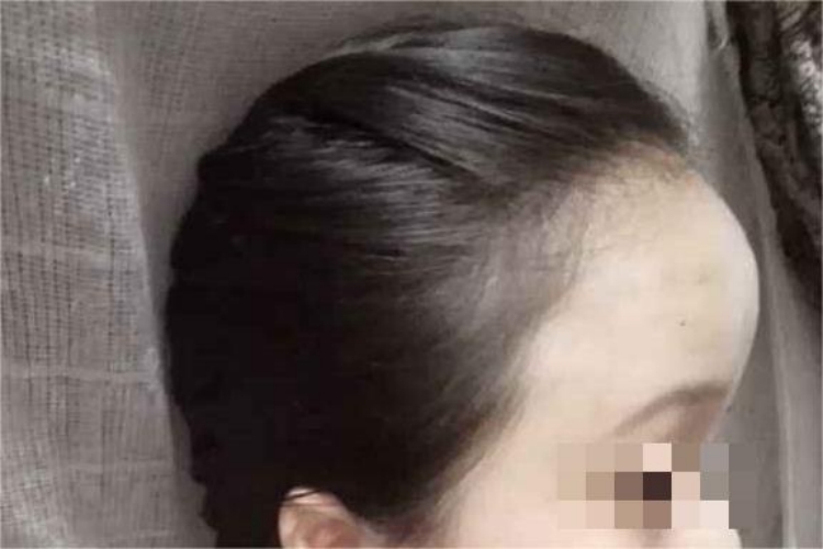 额头凸出来图