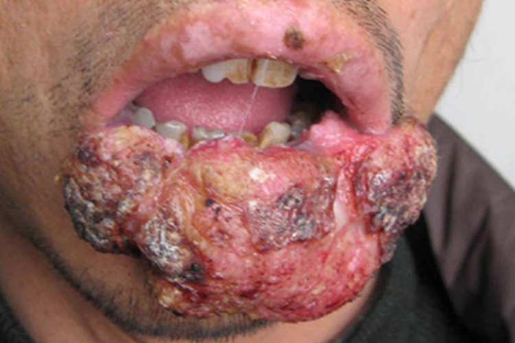 艾滋病皮肤肿瘤嘴唇症状图