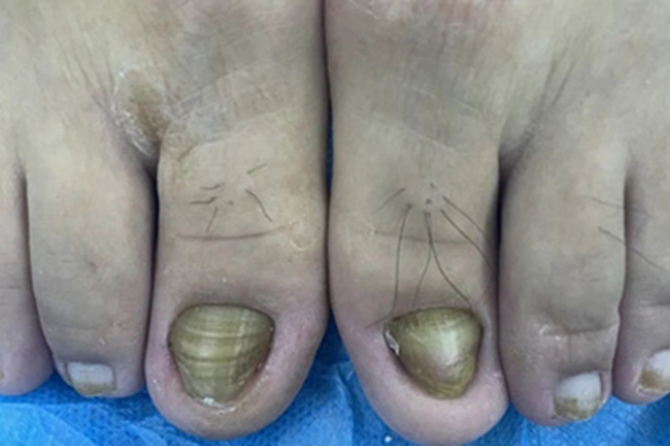 后天性厚甲症脚趾甲发黄图