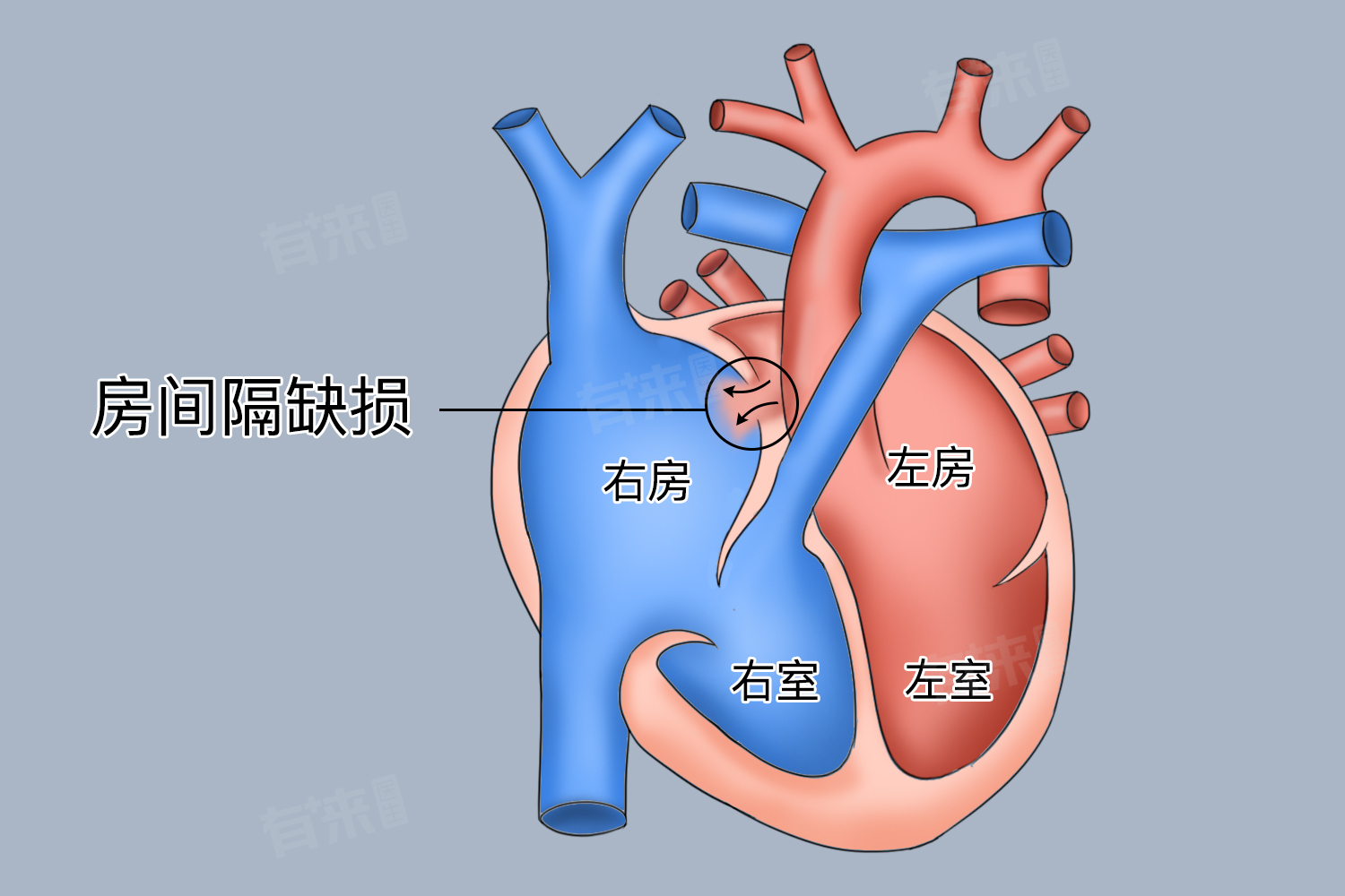 房缺手术后要终身复查吗