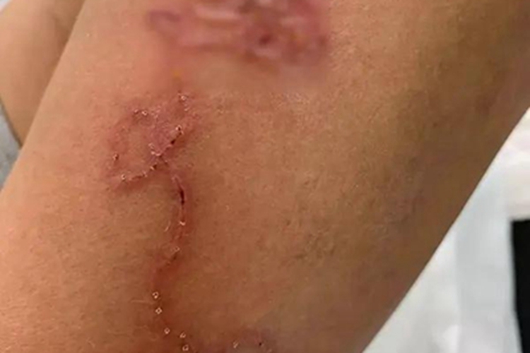 颚口线虫病小腿症状图 颚口线虫病小腿症状图