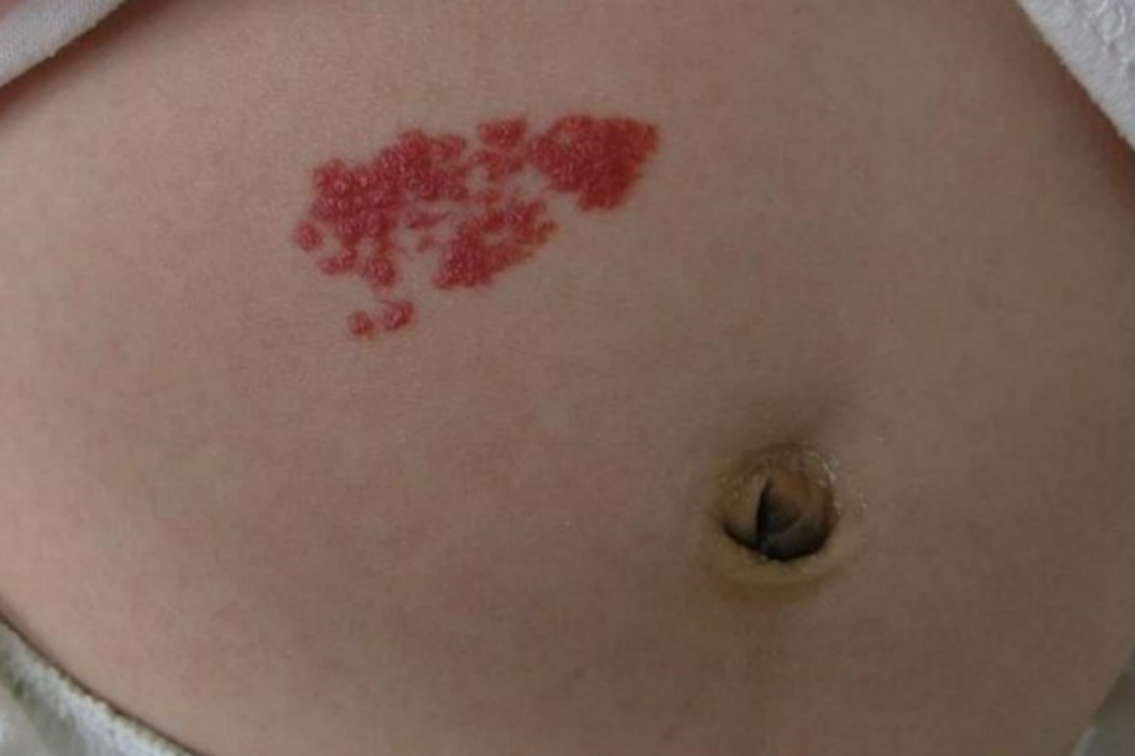 毛细血管瘤红点图 毛细血管瘤红点图