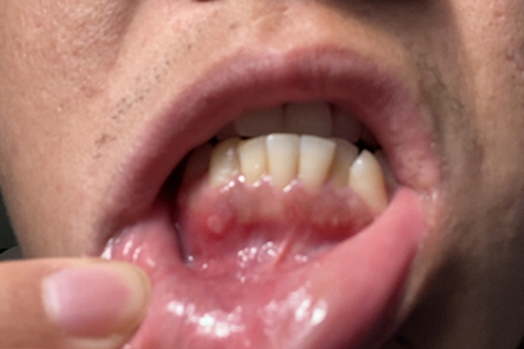 复发性口疮牙龈症状图