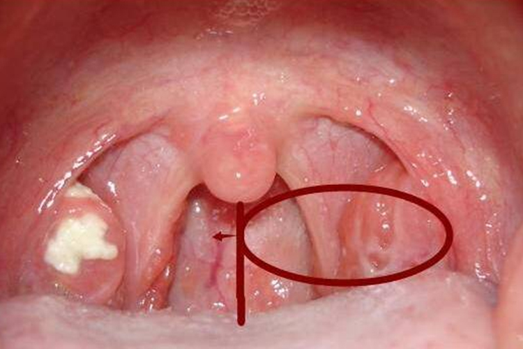 扁桃体一级肿大图
