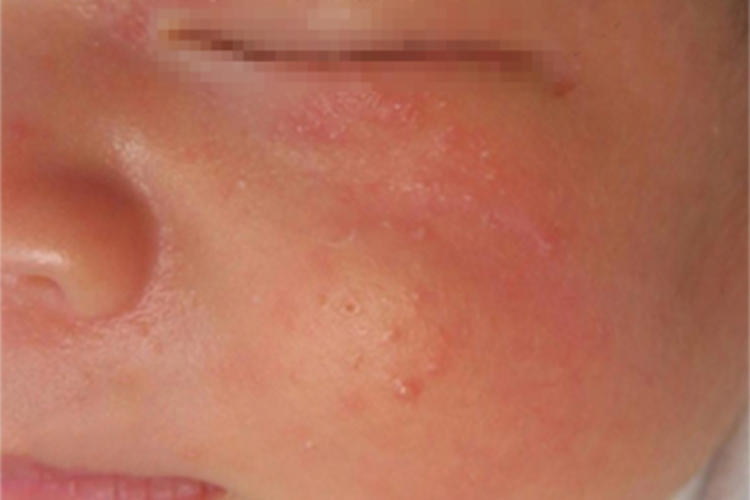 婴儿期特应性皮炎症状图