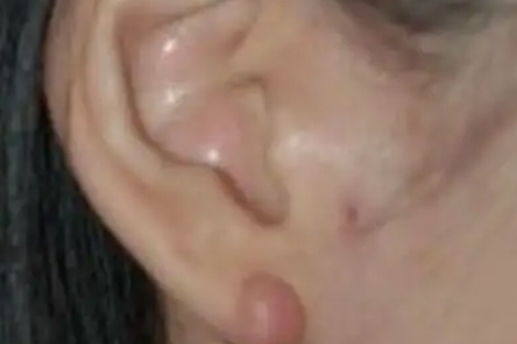 耳垂皮脂腺囊肿图