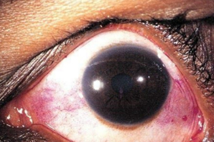 干燥综合征眼白有血丝图