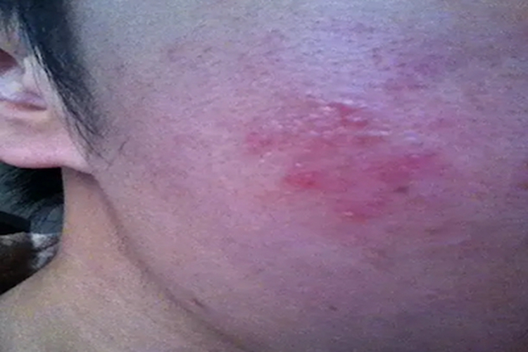 柯萨奇病毒疹面部小红疙瘩图