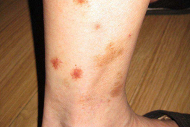 昆虫性皮炎小腿红斑图