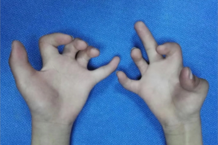 掌腱膜挛缩症手指畸形图