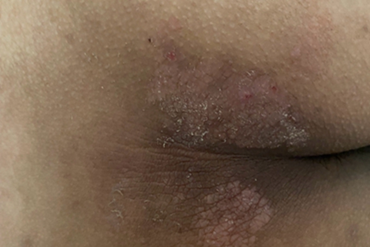 慢性湿疹臀部症状图