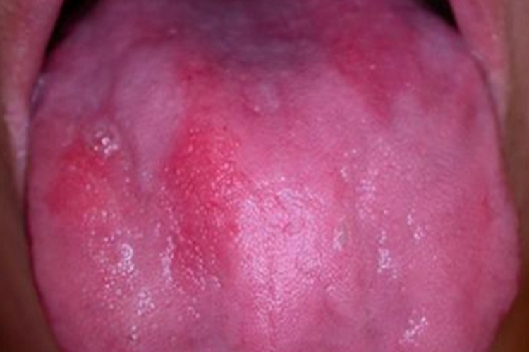 叶酸缺乏症舌头充血图