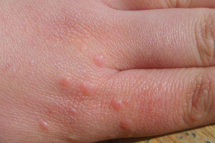 疣状肢端角化病手背丘疹图 疣状肢端角化病手背丘疹图