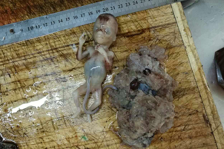 部分性葡萄胎图