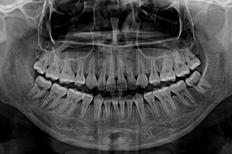 牙齿CT拍摄的全景片图 牙齿CT拍摄的全景片图