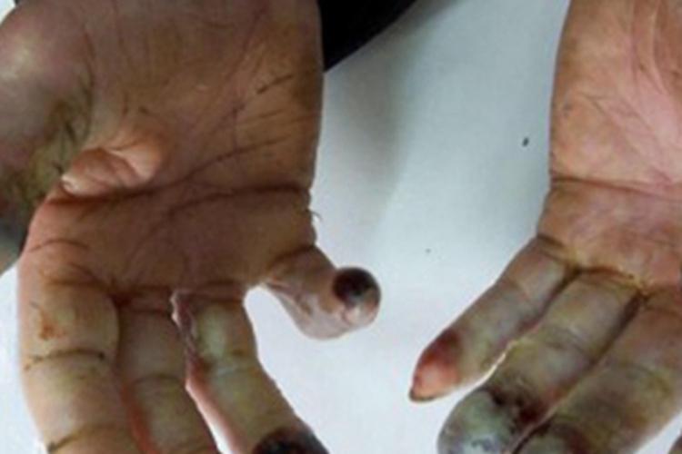 Ⅲ度冻伤皮肤颜色变浅图 Ⅲ度冻伤皮肤颜色变浅图