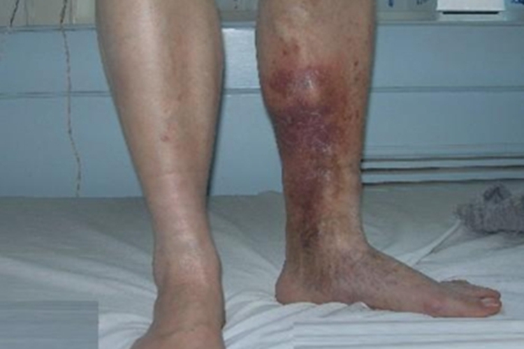 闭塞性血栓性脉管炎第二期红肿图 闭塞性血栓性脉管炎第二期红肿图